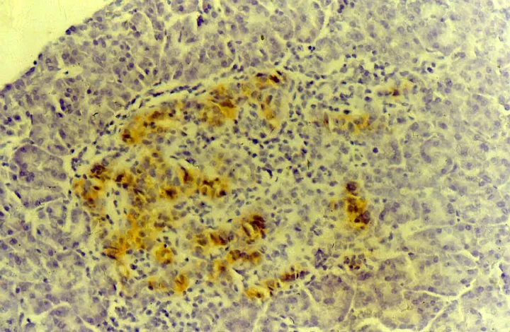 Destruction of islets of Langerhans in Type I diabetes. Credit: Anne Clark, University of Oxford. Attribution 4.0 International (CC BY 4.0) s