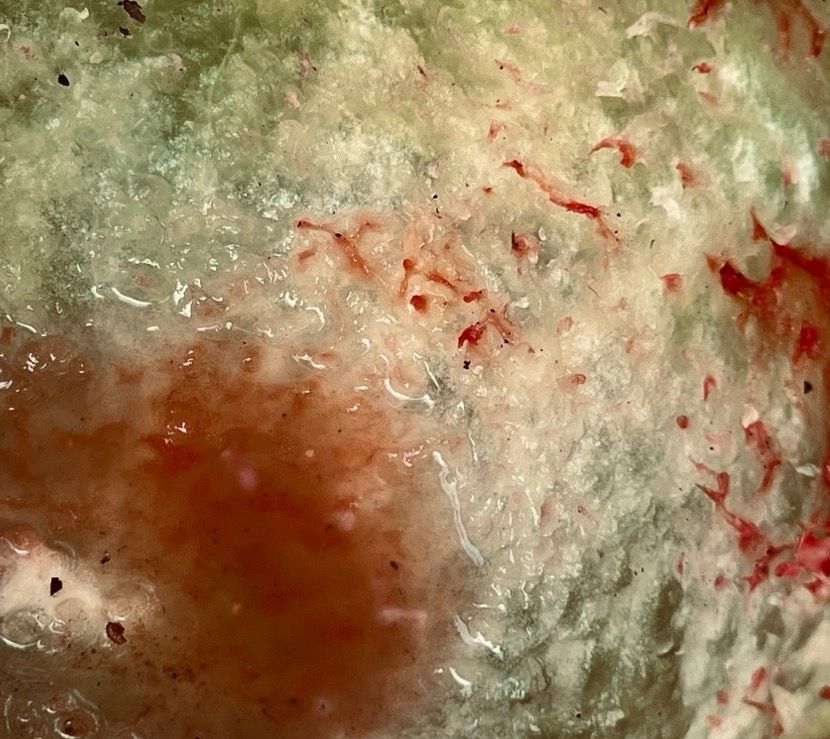 DISEASED CYST VERIFIABLE THANKS